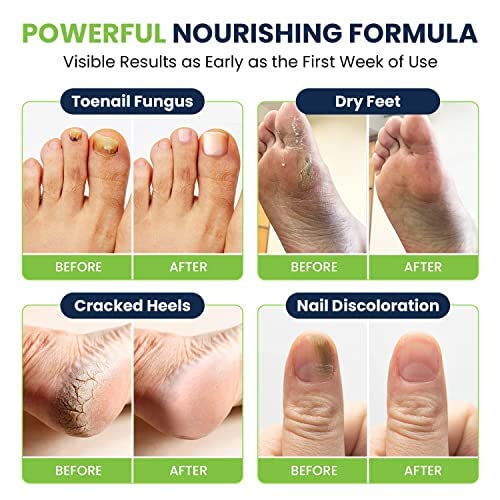 Toenail Fungus Treatment Extra Strength - for fingernails, nail repair, toenail softener, yellow toenail treatment, ingrown nail and foot fungus treatment extra strength