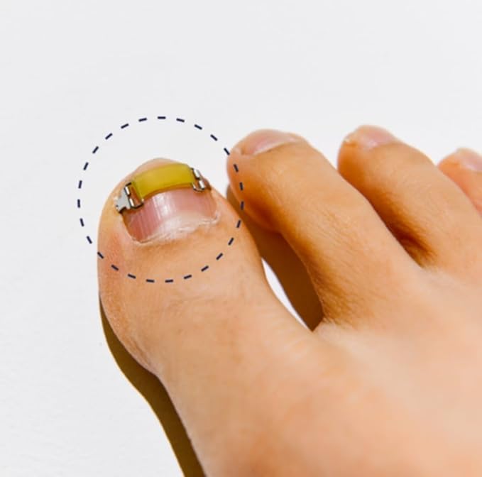 Ingrown Toenail Treatment & Corrector with Latex Elasticity - Curved Toenail Straightener | Effective Daily Solution for Ingrown Toenail Pain & Growth Correction [L/0.78inch/19-21mm]