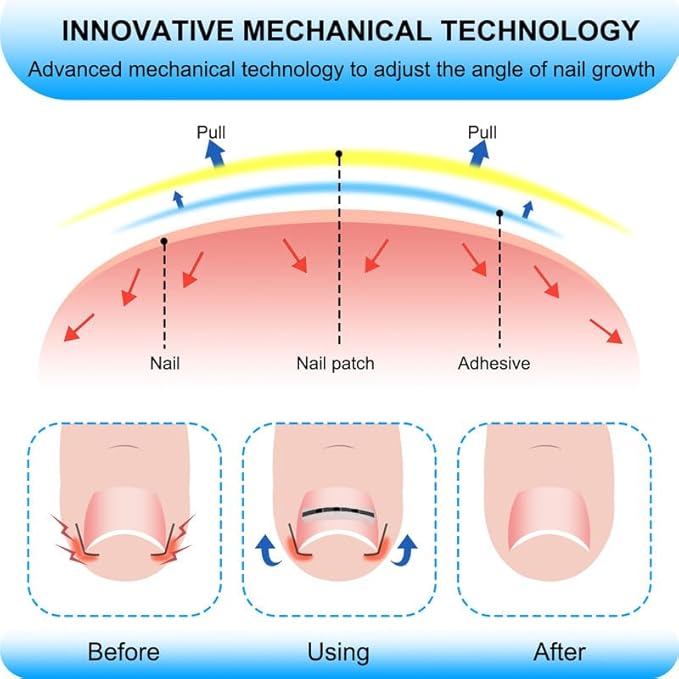 Upgraded ingrown toenail treatment, nail kit, Ingrown Toenail Treatment, Ingrown Toenail Removal Kit, Designed for Curved Nail Repair, Ingrown Toenail Corrector, Suitable for many types of correction.
