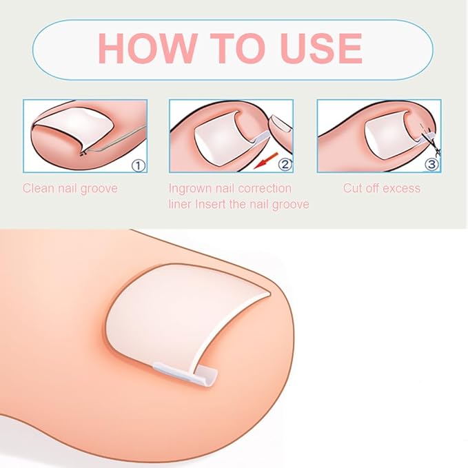 Ingrown Toenail Removal Kit,Professional Toenail Tool Kit Includes Breathable Toenail Strips, Curved Toenails Corrector Patch, Painless File and Lifter Pedicure Tools, Professional Pedicure Tool