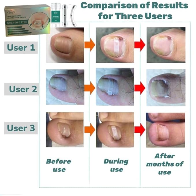 Ingrown Toenail Removal Kit | Titanium Alloy Ingrown Toenail Treatment | Pedicure Tools for Feet, Nail Tools Specially Designed for Curved Nail Repair and Ingrown Toenail Corrector (0.67/0.79in)