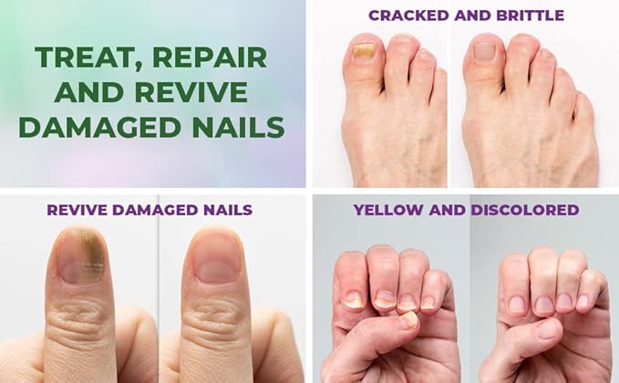 Perfecto Toenail Treatment with Tea Tree Oil - Fingernail and Toe Nail Treatment Extra Strength - Nail Repair Foot Nail Treatment - Renews Foot, Yellow & Cracked Nails