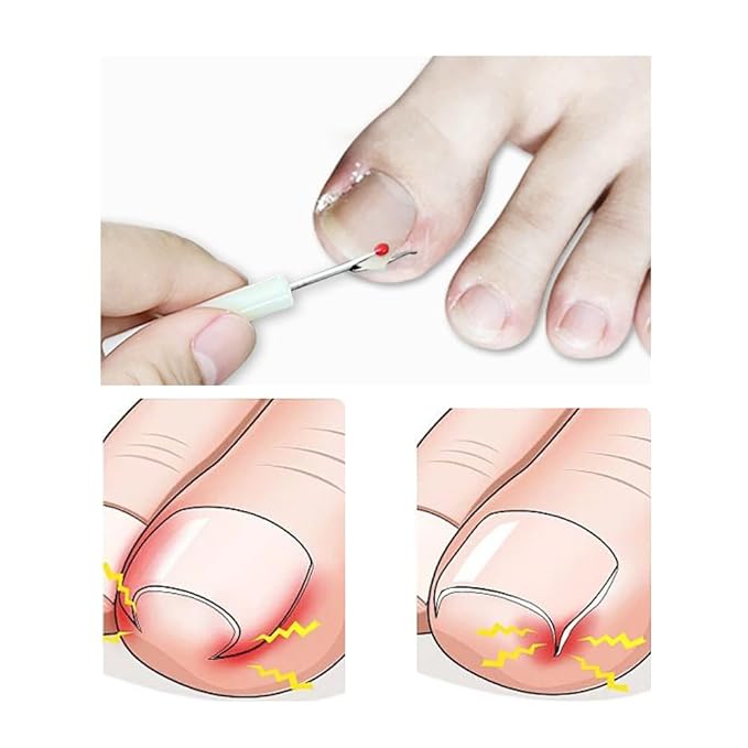10 Pack Ingrown Toenail Lifter Precision Ingrown Toenail Removal Kit Nail Cleaner Pedicure Tools for Ingrown Toenail Corrector Set Ingrown Toenail Treatment Toenails Straightener Strips