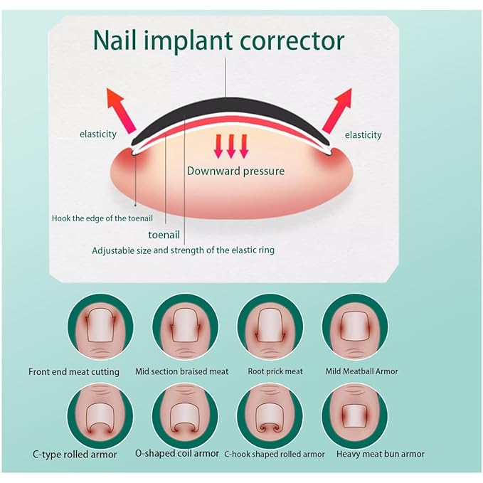 JIUDOUCUOIngrown Toenail correction Kit, Professional Nail Care Tools with Correction Clips and Adhesive Pads，Four correction clips can correct two toenails simultaneously