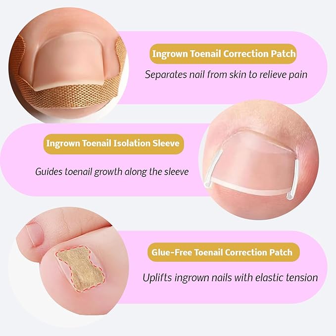 Ingrown Toenail Corrector Kit with Correction Strips, Breathable Ingrown Toenail Tape, Removal Kit for Ingrown Toenails in Women And Men