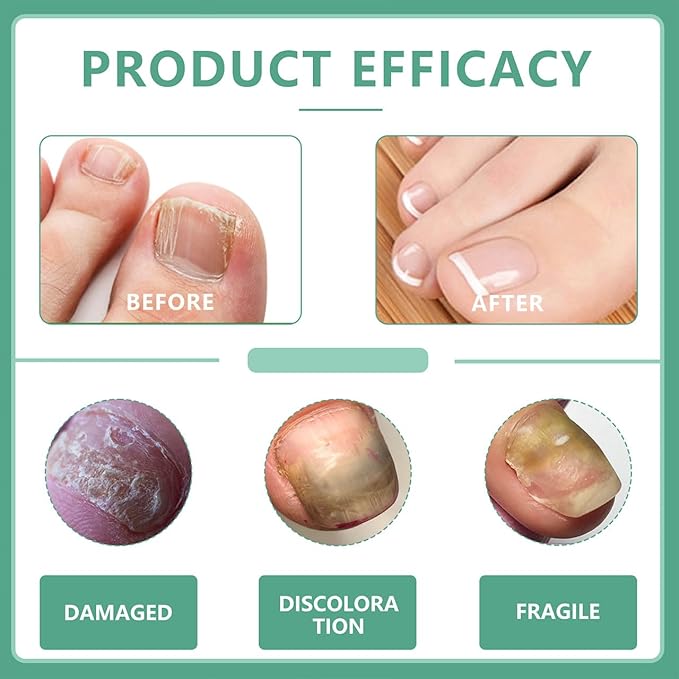 Nail Fungus Pen–Toenail Fungus Treatment Extra Strength for Toe Nail Repair Pen for Damaged Nails - 25% Undecylenic Acid with added Tea Tree Oil(3 PCS)