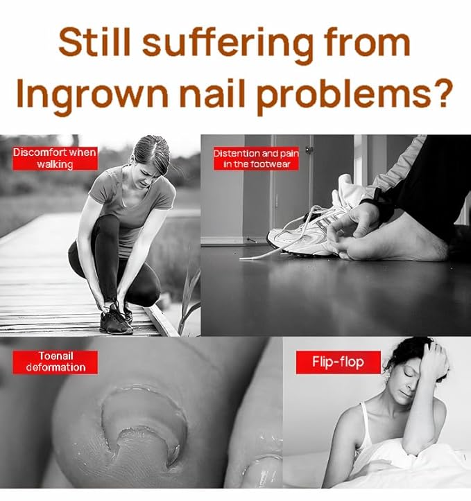 Ingrown Toenail Corrector Kit, 16PC Professional Ingrown Toenail Removal Kit with Correction Strips, Painless Treatment for Ingrown Toenail Pain Relief for Home Pedicure Care