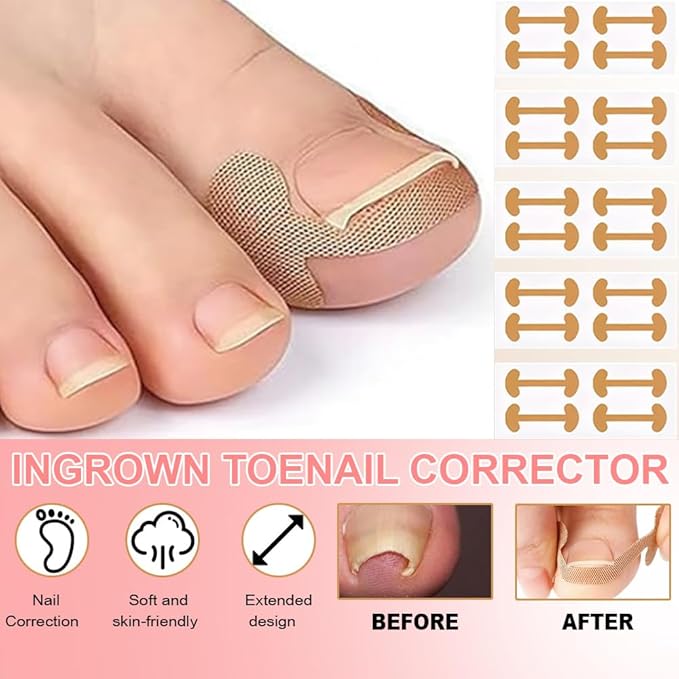 Ingrown Toenail Removal Kit,Professional Toenail Tool Kit Includes Breathable Toenail Strips, Curved Toenails Corrector Patch, Painless File and Lifter Pedicure Tools, Professional Pedicure Tool