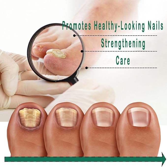 Nail Treatment Gel - 2 PCS Nail Growth Repair Cream for Fingernails and Toenails, Fix & Renew Damage Fungal Nail, Broken, Cracked & Discolored Nails
