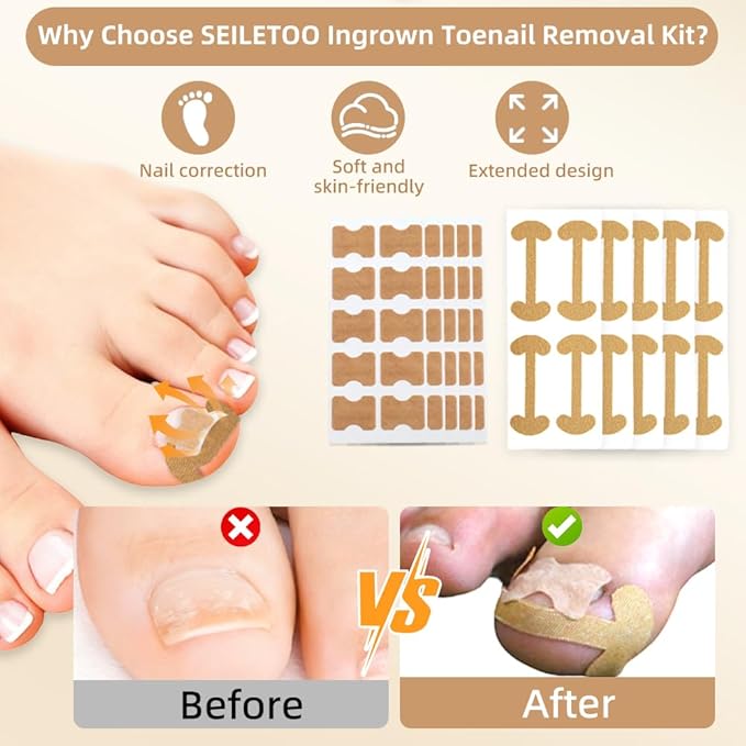 Ingrown Toenail Corrector Set with Breathable Correction Strips, Upgraded Ingrown Toenail Treatment Kit, Curved Toenails Corrector Patch, Pedicure Tools, for Home Use Women Man