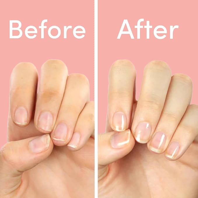 ella+mila Nail Strengthener and Growth Treatment - First Aid Kiss Nail Hardener for Damaged Brittle Thin Nails - Strengthening Polish with Vitamin E - Vegan (2-Pack)