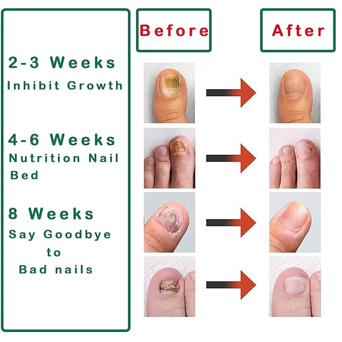 Nail Treatment Gel - 2 PCS Nail Growth Repair Cream for Fingernails and Toenails, Fix & Renew Damage Fungal Nail, Broken, Cracked & Discolored Nails