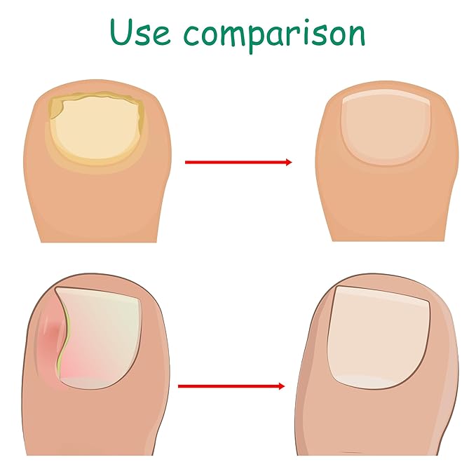 Ingrown Toenail Corrector Kit with Flexible Correction Strips & Tape – Professional Home Pedicure Tool Set for Painless Ingrown Nail Treatment, Toenail Brace & At-Home Care