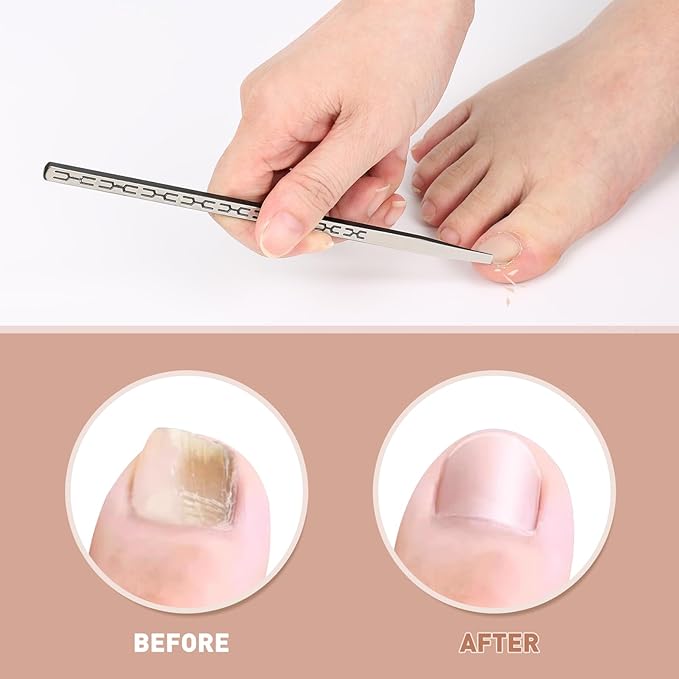 Stainless Steel Ingrown Toenail Pedicure Knife Set,Professional Foot Skin Scraper Repair Sharp Blade Kit For Nail Corn Callus Paronychia Treatment. (5)