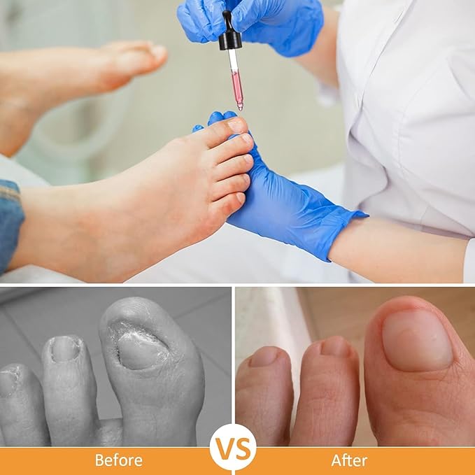 Treatonic Ingrown Toenail Treatment Drops - Ingrown Toenail Softener and Reliever Kit for Easy Trimming with Silicone Gel Toe Caps - 2 Pack