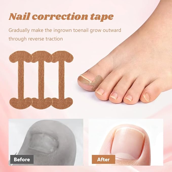 Professional Ingrown Toenail Corrector Set with Correction Strips – Complete Home Pedicure Kit for Men & Women, Non-Slip, Breathable, Pain-Free Relief