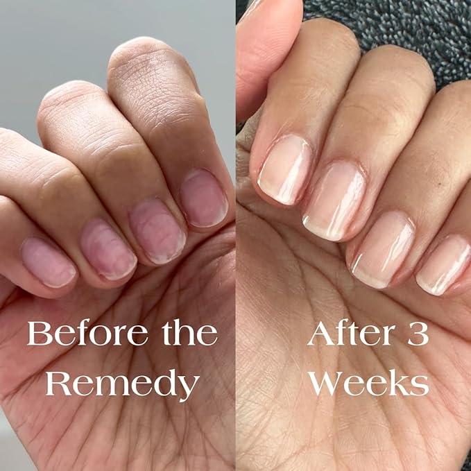 Botanist Nail Rescue Kit | Nail Strengthening Polish + Growth Serum | Grow and Strengthen Nails Damaged from Acrylics, Dip, and Gel Manicures | Non-Toxic, 84% Plant Based, 21-Free & Vegan (Nude)