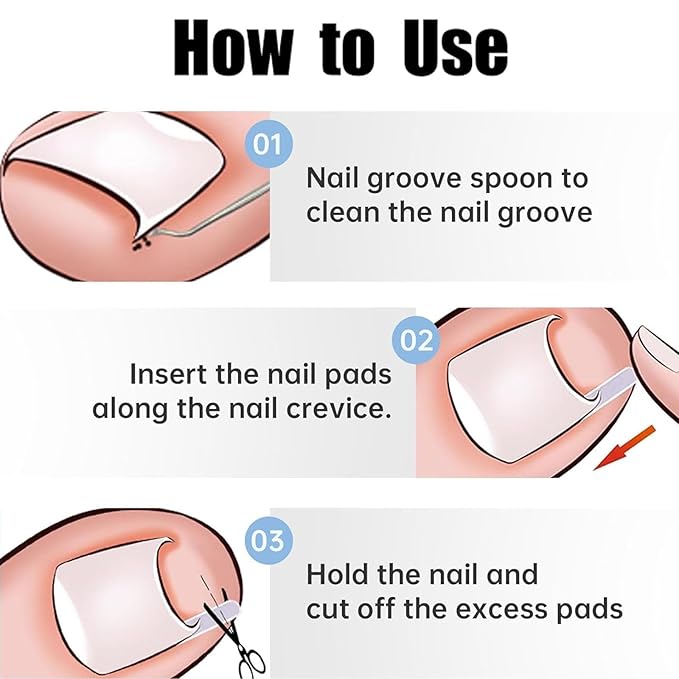 50 Pcs Ingrown Toenail Corrector Set, Toenail Correction Strips Brace Kit, Ingrown Toenails Correction Pad Recover Clips, Toenails Straightener Strips for Women Men's Nail Treatment Pedicure
