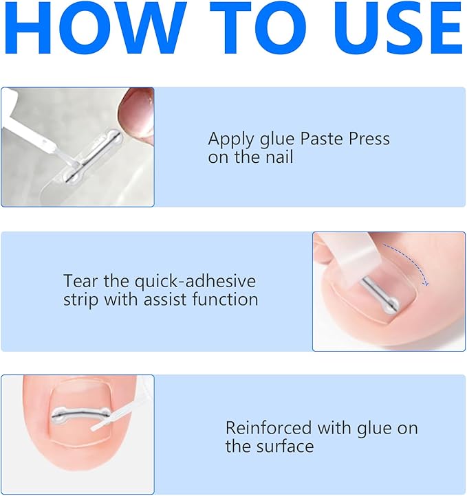 Ingrown Toenail Treatment, Toenail Correction Strips for Curved or Ingrown Nails, Quick Relief, Nail Correction, 5 Different Sizes
