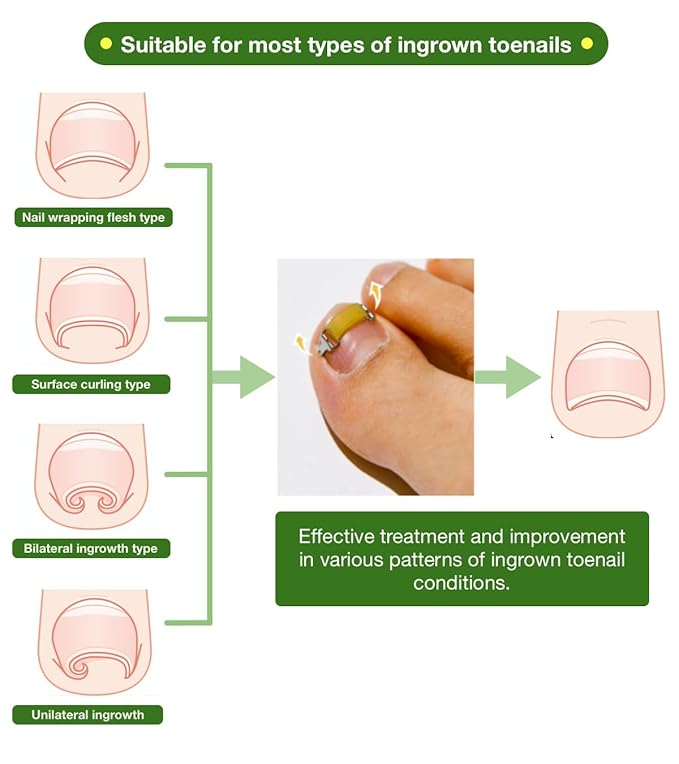 Ingrown Toenail Treatment & Corrector with Latex Elasticity - Curved Toenail Straightener | Effective Daily Solution for Ingrown Toenail Pain & Growth Correction [S/0.67inches/16-18mm]