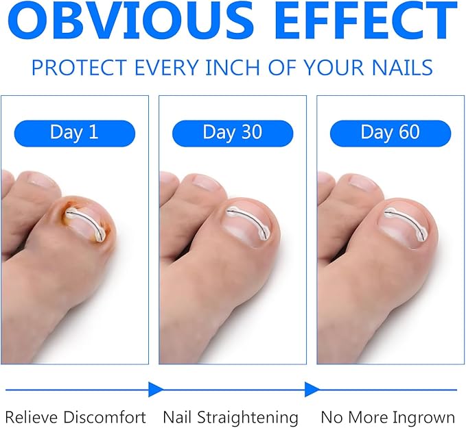 Ingrown Toenail Treatment, Toenail Correction Strips for Curved or Ingrown Nails, Quick Relief, Nail Correction, 5 Different Sizes