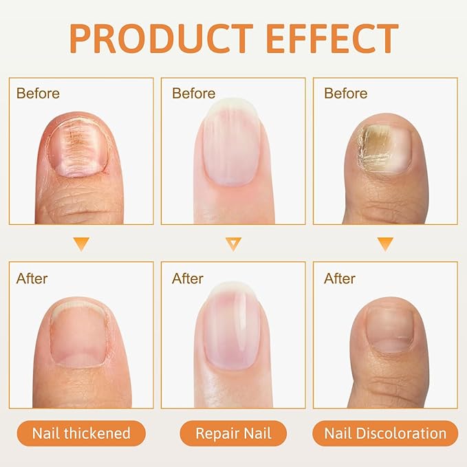 2Pcs Bee Venom Nail Soothing Spray, Advanced Nail Repair Spray, Bee Venom Toe Nail Treatments spray, Nail Care, Gently and Nourishing