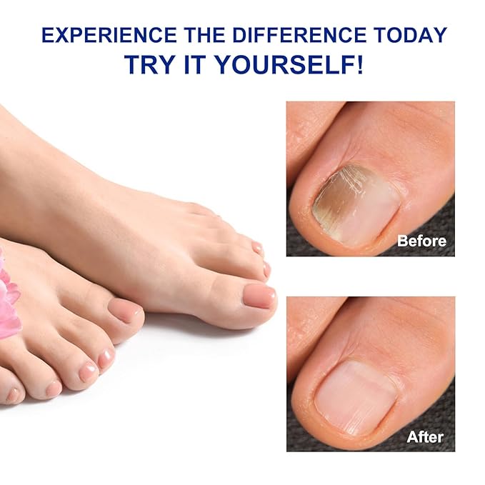 32 Pcs Fungal Nail Patches,Toenail Fungus Treatment Extra Strength - Toe Nail Fungus Treatments for Men and Women, Overnight Renewal Nail Repair Patches