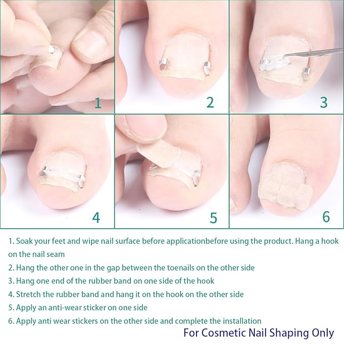 JIUDOUCUOIngrown Toenail correction Kit, Professional Nail Care Tools with Correction Clips and Adhesive Pads，Four correction clips can correct two toenails simultaneously