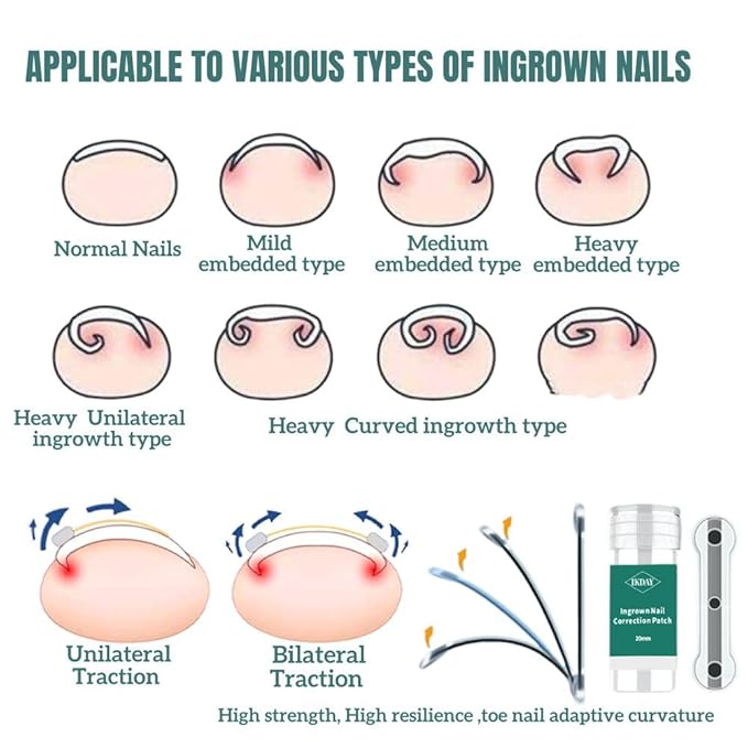Ingrown Toenail Removal Kit | Titanium Alloy Ingrown Toenail Treatment | Pedicure Tools for Feet, Nail Tools Specially Designed for Curved Nail Repair and Ingrown Toenail Corrector (0.67/0.79in)
