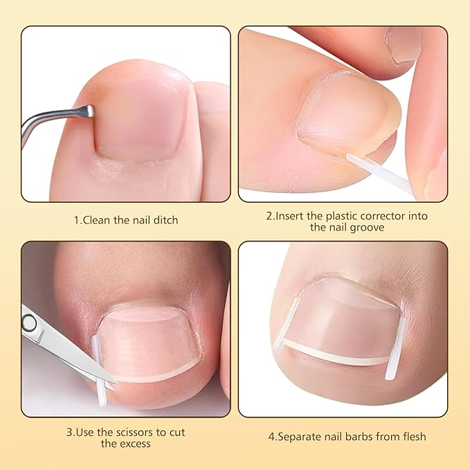 Ingrown Toenail Corrector Set with Magnifier and Correction Strips, Professional Ingrown Toenail Treatment Tools Set, Safe and Effective Nail Care for Home Use