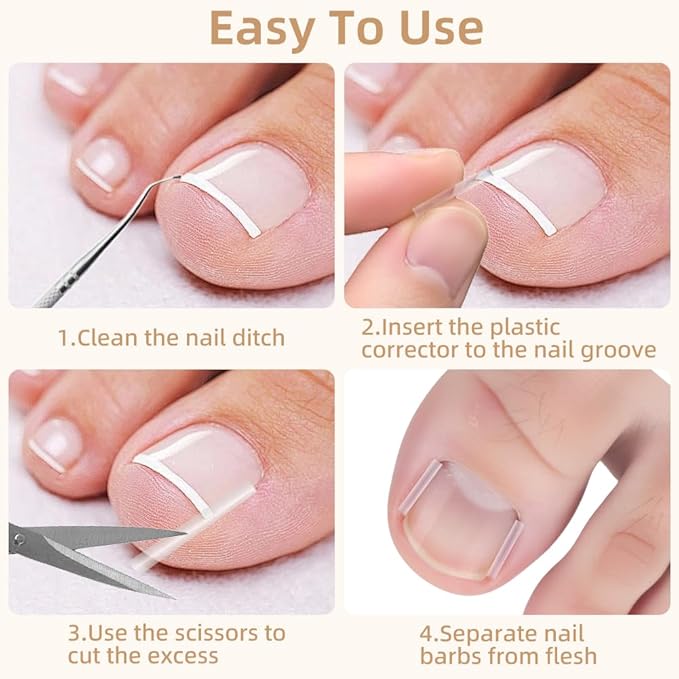 Ingrown Toenail Corrector Set with Breathable Correction Strips, Upgraded Ingrown Toenail Treatment Kit, Curved Toenails Corrector Patch, Pedicure Tools, for Home Use Women Man