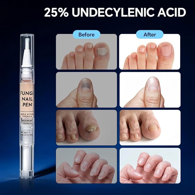 Toenail Fungus Treatment Extra Strength - with 25% Undecylenic Acid - Effective Nail Repair for Damaged Nails, Ingrown Nails & Discoloration - 4-Pack Twist Pen