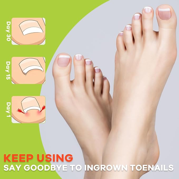 Ingrown Toenail Corrector Kit - Breathable Correction Strips with Nail Lifter Tools, Clippers & File, Toenail Relief for Edges, Home Care Solution