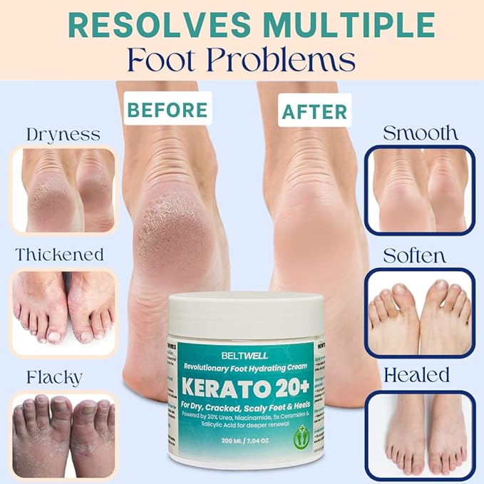 Kerato20+ Urea 20% Intense Foot Hydrating Cream Deep Hydration for Healthy, Smooth Feet. Restores Extremely Dry, Swollen, Cracked Skin, Softens Thick, Scaly Areas, and Breaks Down Calluses