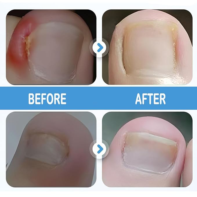 Professional Ingrown Toenail Set with Breathable Ingrown Toenail Strips,Toenail Correction Strips, Curved Toenails Corrector Patch, Painless File and Lifter Pedicure Tools