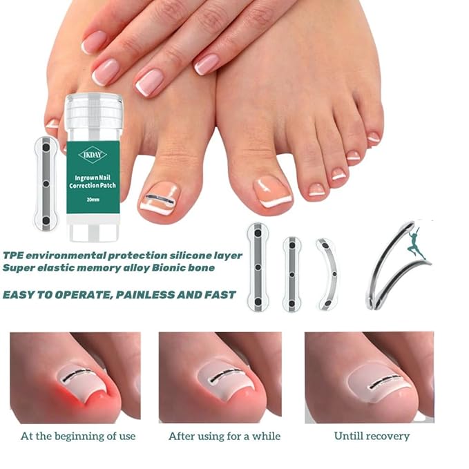 Ingrown Toenail Removal Kit | Titanium Alloy Ingrown Toenail Treatment | Pedicure Tools for Feet, Nail Tools Specially Designed for Curved Nail Repair and Ingrown Toenail Corrector (0.67/0.79in)