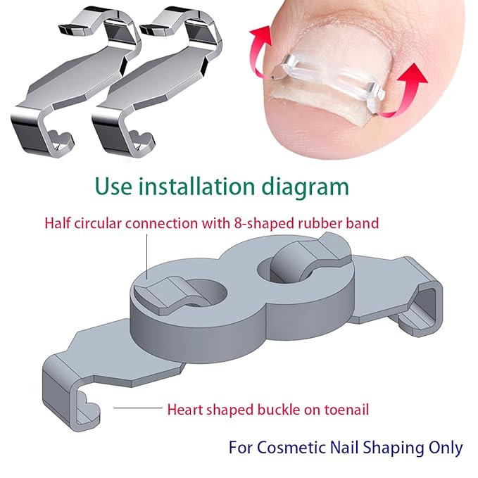 JIUDOUCUOIngrown Toenail correction Kit, Professional Nail Care Tools with Correction Clips and Adhesive Pads，Four correction clips can correct two toenails simultaneously
