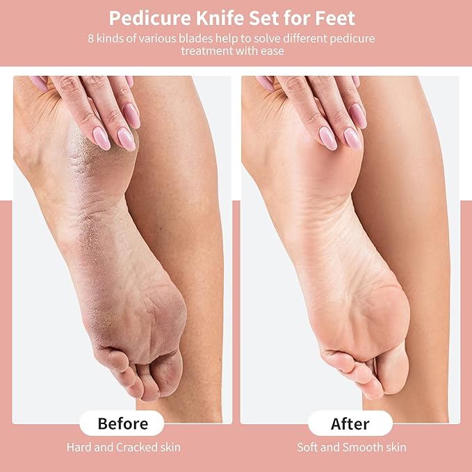 Pedicure Knife Kit, 5 Pack Rose Gold Foot Dead Callus Remover Stainless Set, Professional Ingrown Toenail Steel Tool, Feet Skin Care Nail File Tool Manicure Clippers Cuticle Scraper Toe Shaver