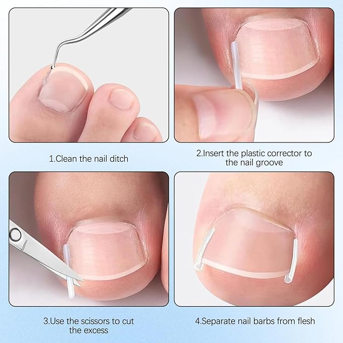 Ingrown Toenail Corrector Set with Breathable Toenail Strips, Curved Nail Corrector Patch, File and Lifter, Professional Pedicure Tools for Men and Women, Easy At-Home Toenail Care Kit