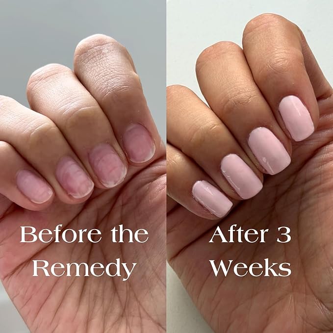 Botanist Nail Rescue Kit | Strengthening Polish + Growth Serum | Grow and Strengthen Nails Damaged from Acrylics, Dip, and Gel Manicures | Non-Toxic, 84% Plant Based, 21-Free & Vegan (Cherry Blossom)