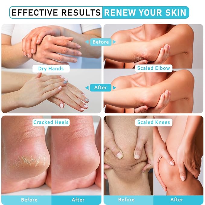 Urea Cream 40% Maximum Strength with Vitamin E & Salicylic Acid - Foot Cream for Winter Dry Cracked Heels - Intense Moisturizer for Hands, Feet & Body - Callus Remover - Lightweight Non-Greasy Formula
