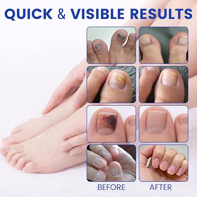 Toenail Fungus Treatment Extra Strength - 21 Pcs Fungal Nail Patches, 8-Hour Firm Adhesion, Nail Repair for Damaged Nails, Overnight Renewal for Men & Women (1 Count (Pack of 21))