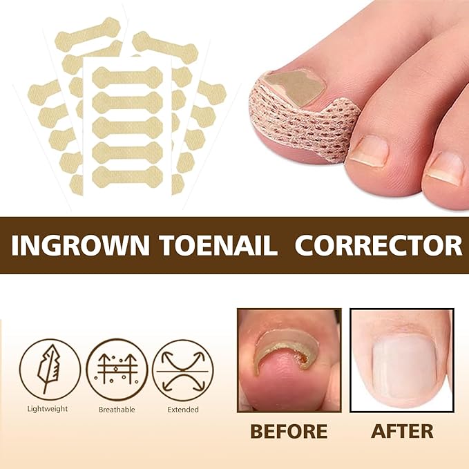 Ingrown Toenail Corrector Set with Magnifier and Correction Strips, Professional Ingrown Toenail Treatment Tools Set, Safe and Effective Nail Care for Home Use