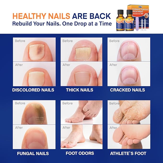 Toenail Fungus Treatment with 25% Undecylenic Acid: Toenail Fungus Treatment Extra Strength for Thick, Yellow and Damaged Nails - Safe and Gentle for Nails Care