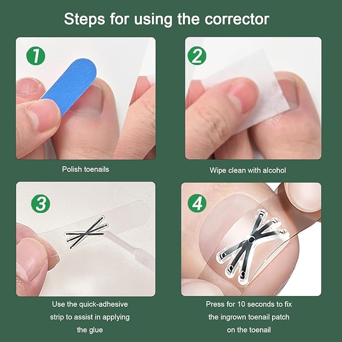 Titanium Alloy Ingrown Toenail Corrector Kit, Toenail Brace Tools for Curved and Ingrown Nails, Self-Adhesive Nail Correction Strips, 2 Sizes (0.63 & 0.67 in)