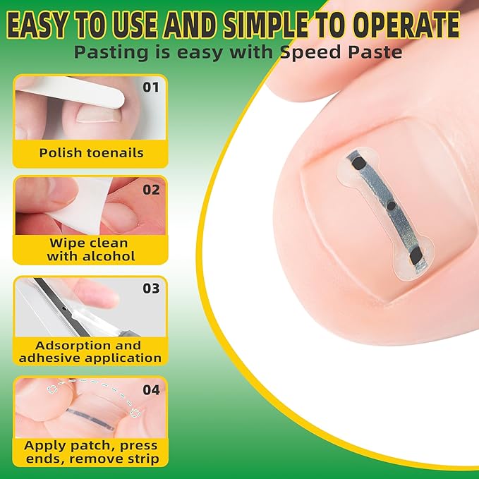 Ingrown Toenail Treatment Kit, Titanium Alloy Ingrown Toenail Removal Kit, Nails Corrector Tool & Remover Strips - Ingrown Toe Nail Quick Relief