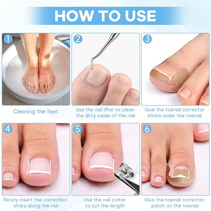 Ingrown Toenail Removal Kit with Ingrown Toenail Strips, Curved Toenails Corrector Patch, Nail File and Lifter Pedicure Tools for Women Man