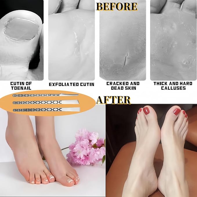 4 PCS Stainless Steel ingrown toenail Pedicure Knife Set,Professional Pedicure Knife Set,Dead Skin Corn Foot Callus Remover Kit