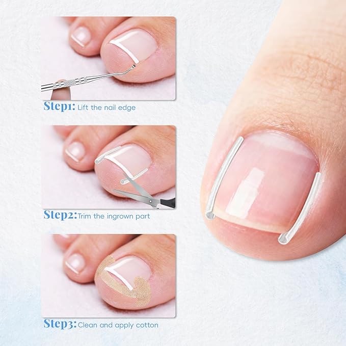 Professional Ingrown Toenail Set, Nail Care, Professional Pedicure Tools Set for Toenail Care, Stainless Steel Clippers, Lifter, File & Nail Cleaner, Painless File and Lifter Pedicure Tools