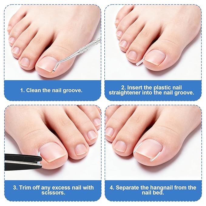 Professional Ingrown Toenail Removal Kit, Including Ingrown Toenail C-Shaped Patch Tools, Wide Nail Corrector Sticker, Correction Sticker Strips & Toe Separator, etc for Home Pedicure